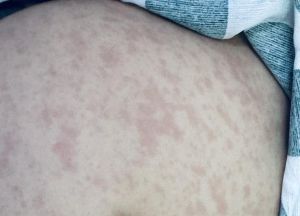 Nhiều trẻ chưa đến tuổi tiêm vaccine bị bệnh sởi nặng