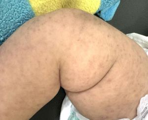 Bác sĩ hướng dẫn cách chăm sóc trẻ bị bệnh sởi đúng cách
