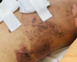 Cảnh báo tai nạn pháo nổ dịp cận Tết Nguyên đán