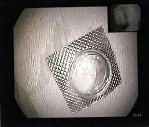 Bác sĩ thực hiện thành công ca nội soi gắp dị vật sắc nhọn trong thực quản bệnh nhân