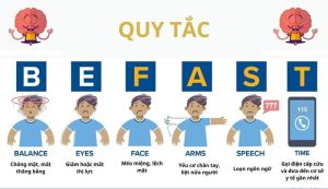 Bệnh viện Thuận Mỹ ITO Đồng Nai cấp cứu thành công cho bệnh nhân bị đột quỵ nặng