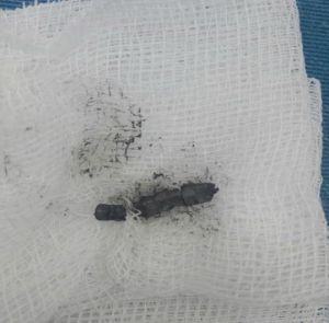 Phẫu thuật cấp cứu bé gái 2 tuổi bị thủng ruột, thủng dạ dày do nuốt 27 cục nam châm