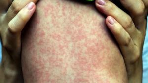 Những biến chứng nguy hiểm của bệnh sởi
