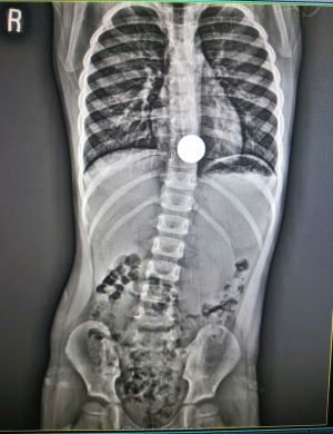 Gắp đồng xu lớn vướng trong thực quản bé trai