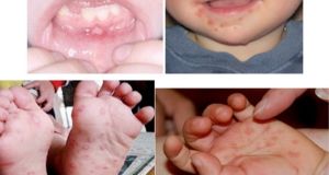 Cẩn trọng với bệnh tay chân miệng