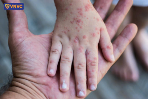 Xã Nha Bích tăng cường các biện pháp phòng, chống dịch bệnh Tay chân miệng