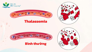 Thalasamia