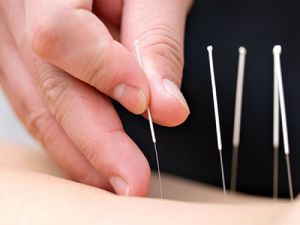 CHÂM CỨU ĐIỀU TRỊ BÍ TIỂU SAU SINH