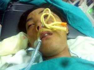 Cải tiến nhét mechè mũi sau trong chảy máu mũi bằng Sonde foley tại bệnh viện ĐKKV Định Quán