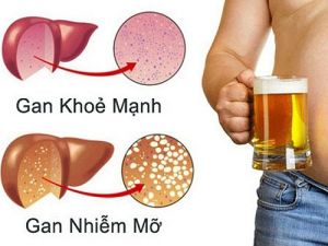 Bệnh gan do rượu bia