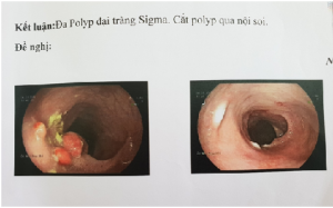 THỰC HIỆN THÀNH CÔNG NỘI SOI CẮT ĐÔT ĐA POLYP Ở BÉ TRAI 4 TUỔI