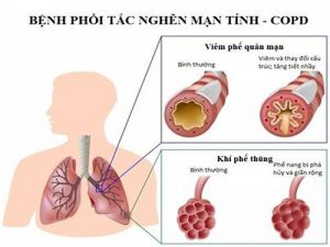 Bệnh phổi tắc nghẽn mạn tính