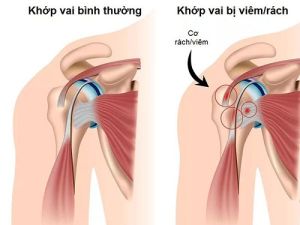 Bệnh lý khớp vai không thể coi thường