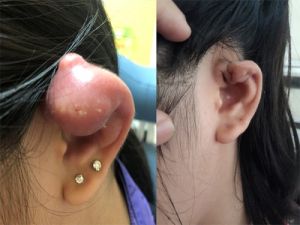 Cẩn trọng khi xỏ khuyên tai