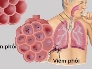 Bộ Y tế khuyến cáo về phòng chống viêm phổi cấp do chủng vi rút mới tại Trung Quốc