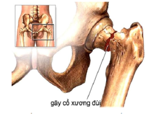 Cụ bà 75 tuổi bị gãy cổ xương đùi đi lại được sau 18 giờ phẫu thuật