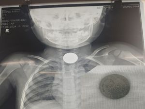 Gắp thành công đồng xu ra khỏi thực quản bệnh nhi