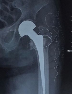 Phẫu thuật thay khớp háng thành công cho cụ bà 95 tuổi