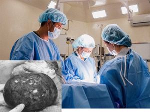 Cắt khối u ác tính trực tràng thấp bằng phương pháp mới