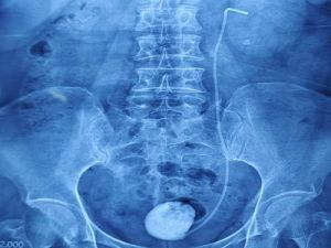 Phẫu thuật gắp ống nhựa bám nhiều sỏi bị bỏ quên suốt 4 năm trong cơ thể