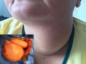 Phẫu thuật bóc tách bướu cổ “khủng” cho nữ bệnh nhân