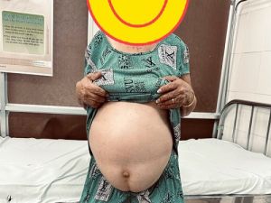 Bệnh viện ĐKKV Định Quán mổ thành công ca u nang buồng trứng khủng