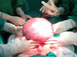Bóc khối u xơ nặng 1,8kg cho bệnh nhân