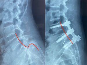 Phẫu thuật thành công cho bệnh nhân bị trượt thân sống mức độ nặng