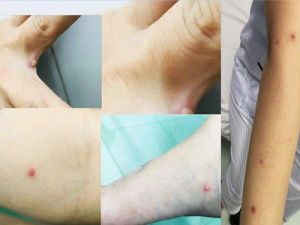 6 biện pháp phòng bệnh đậu mùa khỉ