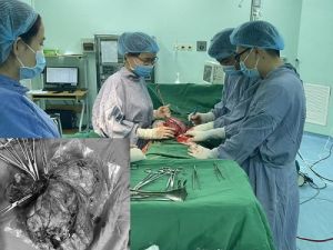Bệnh viện ĐKKV Long Khánh cắt khối u xơ tử cung nặng gần 2kg cho nữ bệnh nhân