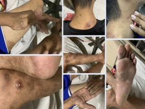 Trường hợp nguy cơ cao mắc bệnh đậu mùa khỉ và cách phòng tránh