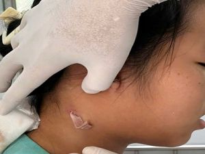 Các biện pháp phòng bệnh Whitmore