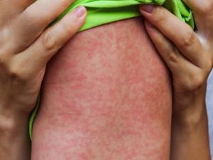 Hướng dẫn chăm sóc trẻ bị sởi đúng cách