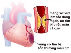 Cứu sống bệnh nhân ngưng tim 3 phút do nhồi máu cơ tim