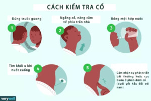 Kế hoạch triển khai Khám sàng lọc và điều tra bướu cổ cho trẻ em 8-10 tuổi