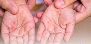 Tuyên truyền phòng chống dịch bệnh tay chân miệng