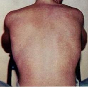 Sốt xuất huyết cách điều trị tại nhà