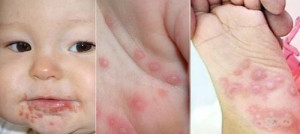 THÔNG ĐIỆP TRUYỀN THÔNG PHÒNG, CHỐNG BỆNH TAY CHÂN MIỆNG