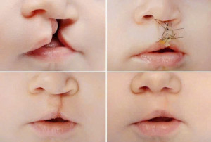 Trạm y tế xã Xuân Đông thông báo đăng ký phẫu thuật miễn phí cho trẻ bị sức môi, hở hàm ếch. 