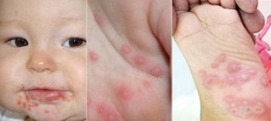 BÀI TUYÊN TRUYỀN PHÒNG CHỐNG BỆNH TAY CHÂN MIỆNG