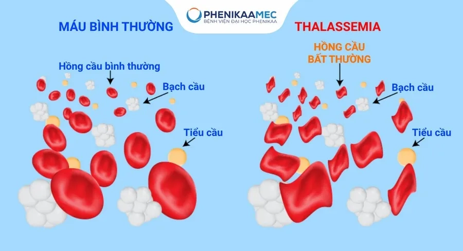 Chung tay phòng bệnh tan máu bẩm sinh vì sức khỏe cộng đồng và tương lai đất nước